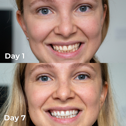 BLU Teeth Whitening Kit
